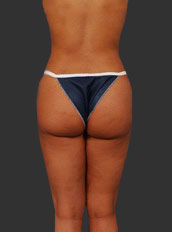 Woman's body, after Brazilian Butt Lift treatment, b-side view, patient 5