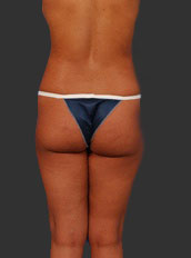 Woman's body, before Brazilian Butt Lift treatment, b-side view, patient 5