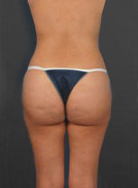 Woman's body, after Brazilian Butt Lift treatment, b-side view, patient 6