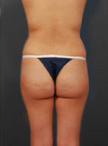 Woman's body, before Brazilian Butt Lift treatment, b-side view, patient 6