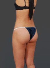 Woman's body, after Brazilian Butt Lift treatment, r-side back view, patient 7