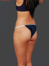 Woman's body, before Brazilian Butt Lift treatment, r-side back view, patient 7