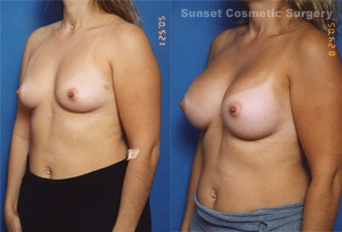 Woman's breasts, before and after Breast Augmentation treatment with natural result, l-side view - patient 11