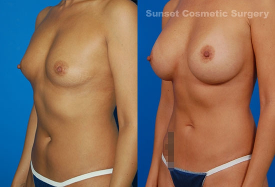 Woman's breasts, before and after Natural Silicone Breast Augmentation treatment, l-side oblique view, patient 17