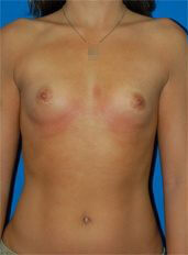 Woman's breasts, before Breast Augmentation (Implants) treatment, front view, patient 35