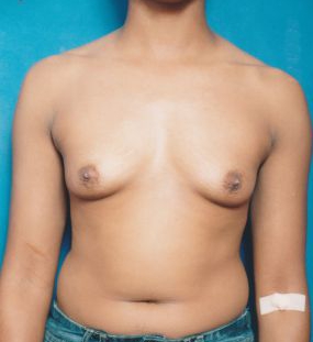 Woman's breasts, before Breast Augmentation (Implants) treatment, front view, patient 370