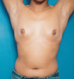 Woman's breasts, before Breast Augmentation (Implants) treatment, front view (hands up), patient 370