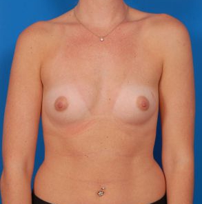 Woman's breasts, before Breast Augmentation, Silicone Implants treatment, front view, patient 36