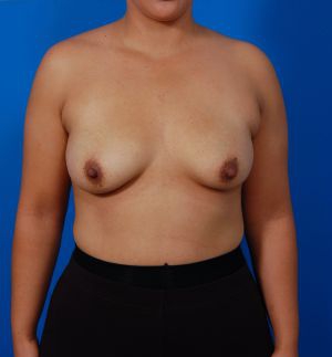 Woman's breasts, before Silicone Breast Augmentation treatment, front view, patient 2
