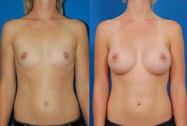 Woman's breasts, before and after Silicone Breast Augmentation treatment in LA, front view, patient 6