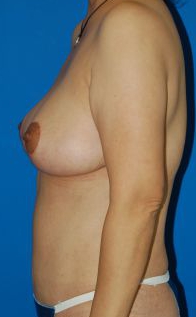Woman's breasts, after Breast Lift treatment, l-side view, patient 25
