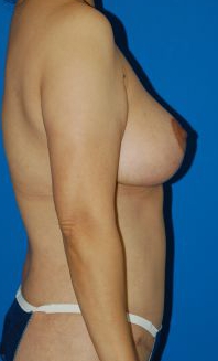 Woman's breasts, after Breast Lift treatment, r-side view, patient 25