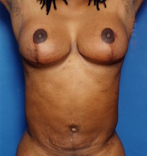 Woman's breasts, after Breast Lift treatment, front view (hands up), patient 122