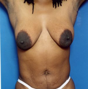 Woman's breasts, before Breast Lift treatment, front view (hands up), patient 122