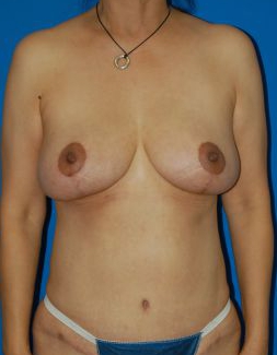 Woman's breasts, after Breast Lift treatment, front view, patient 25