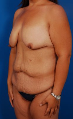 Woman's breasts, before Breast Lift treatment, l-side oblique view, patient 26