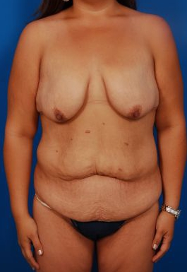 Woman's breasts, before Breast Lift treatment, front view, patient 26