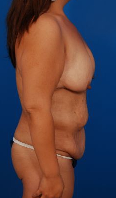 Woman's breasts, before Breast Lift treatment, r-side view, patient 26