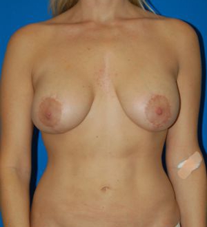 Woman's breasts, before Breast Lift treatment, front view, patient 26