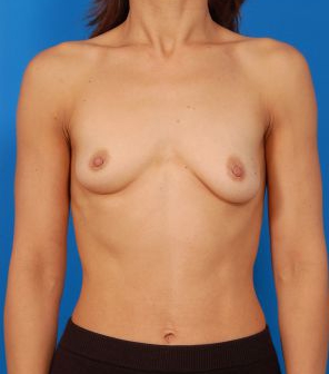 Woman's breasts, before Breast Asymmetry treatment, front view, patient 3