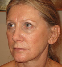 Female face, after Endermologie Sessions treatment, l-side view, patient 3