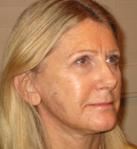 Female face, before Endermologie Sessions treatment, r-side oblique view, patient 3