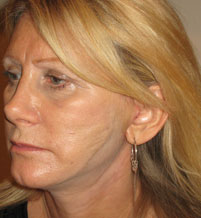 Female face, before Endermologie Sessions treatment, l-side oblique view, patient 3