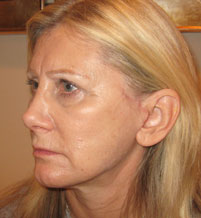 Female face, after Endermologie Sessions treatment, l-side oblique view, patient 3