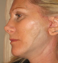 Female face, before Endermologie Sessions treatment, l-side view, patient 3