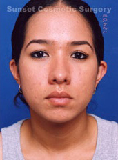 Woman's face, after Eyelid Surgery treatment, front view, patient 4