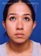 Woman's face, after Eyelid Surgery treatment, front view (eyes looks up), patient 4