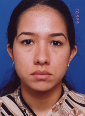 Woman's face, before Eyelid Surgery treatment, front view, patient 4