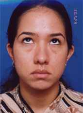 Woman's face, before Eyelid Surgery treatment, front view (eyes looks up), patient 4