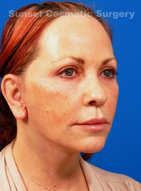 Woman's face, after Eyelid Surgery treatment, r-side oblique view, patient 7