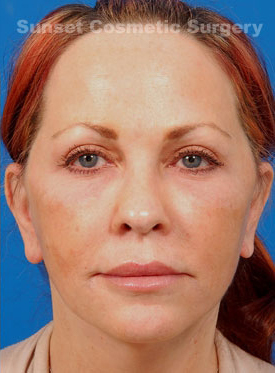 Woman's face, after Eyelid Surgery treatment, front view, patient 7