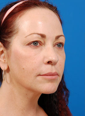 Woman's face, before Eyelid Surgery treatment, r-side oblique view, patient 7