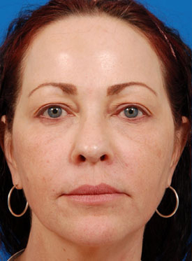 Woman's face, before Eyelid Surgery treatment, front view, patient 7
