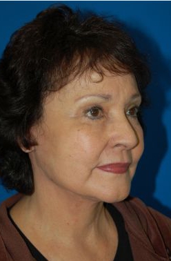 Female face, after Facelift treatment, patient 10 r-side oblique view
