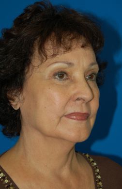 Female face, before Facelift treatment, patient 10 r-side oblique view