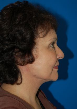 Female face, after Facelift treatment, patient 10 r-side view