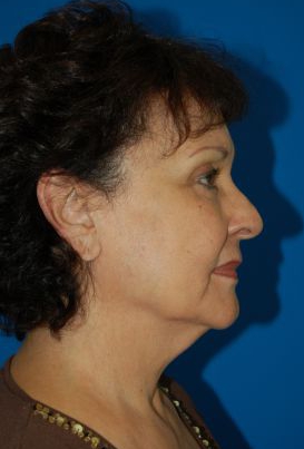 Female face, before Facelift treatment, patient 10 r-side view