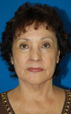 Female face, before Facelift treatment, patient 10 Frontal view