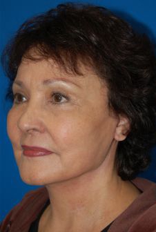 Female face, after Facelift treatment, patient 10 l-side oblique view