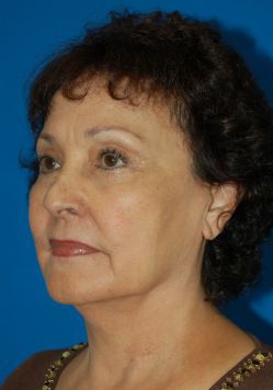 Female face, before Facelift treatment, patient 10 l-side oblique view