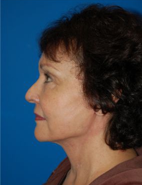 Female face, after Facelift treatment, patient 10 l-side oblique view