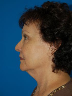 Female face, before Facelift treatment, patient 10 l-side view