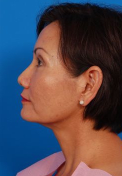 Woman's face, after Brow Lift, Forehead Lift treatment, l-side view, patient 12