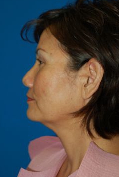 Woman's face, before Brow Lift, Forehead Lift treatment, l-side view, patient 12