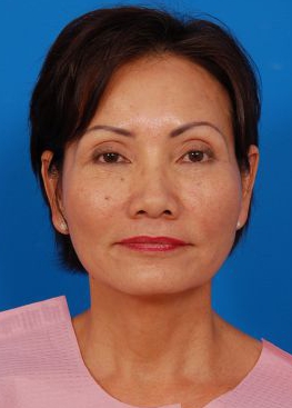 Woman's face, after Brow Lift, Forehead Lift treatment, front view, patient 12