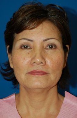 Woman's face, before Brow Lift, Forehead Lift treatment, front view, patient 12